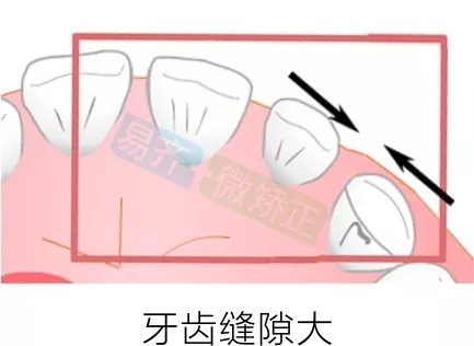 易齐微矫正方案:牙齿缝隙大