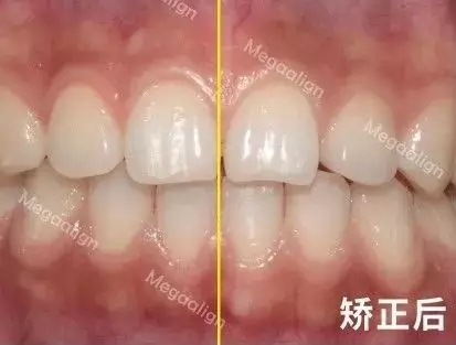 牙齿矫正后
