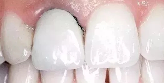 该把烤瓷牙换全瓷牙啦!(好麻烦!早知就做矫正+贴面好了)