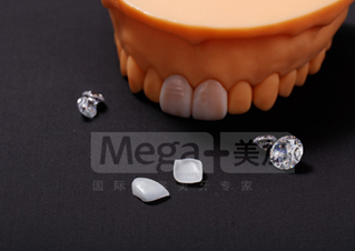 全瓷贴面是什么？