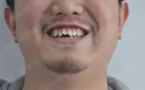 美加案例丨牙齿缺损,美加瓷贴面修复案例一则