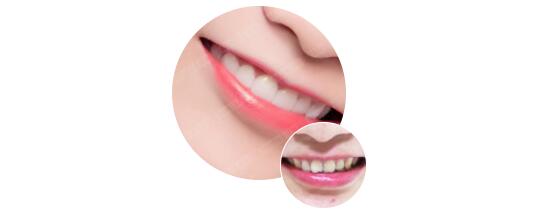 美加美牙贴面前后
