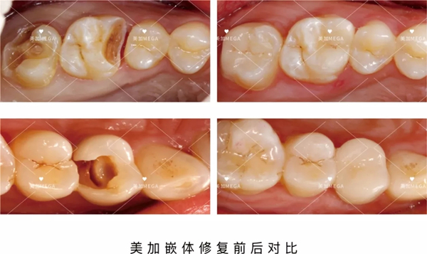 美加嵌体修复前后对比