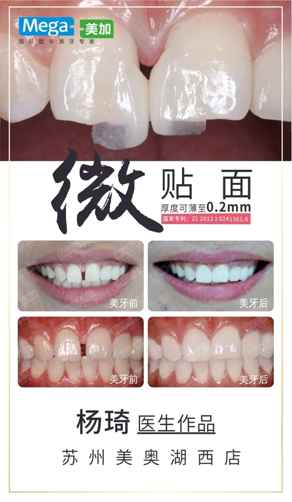 微贴面关闭牙缝隙病例
