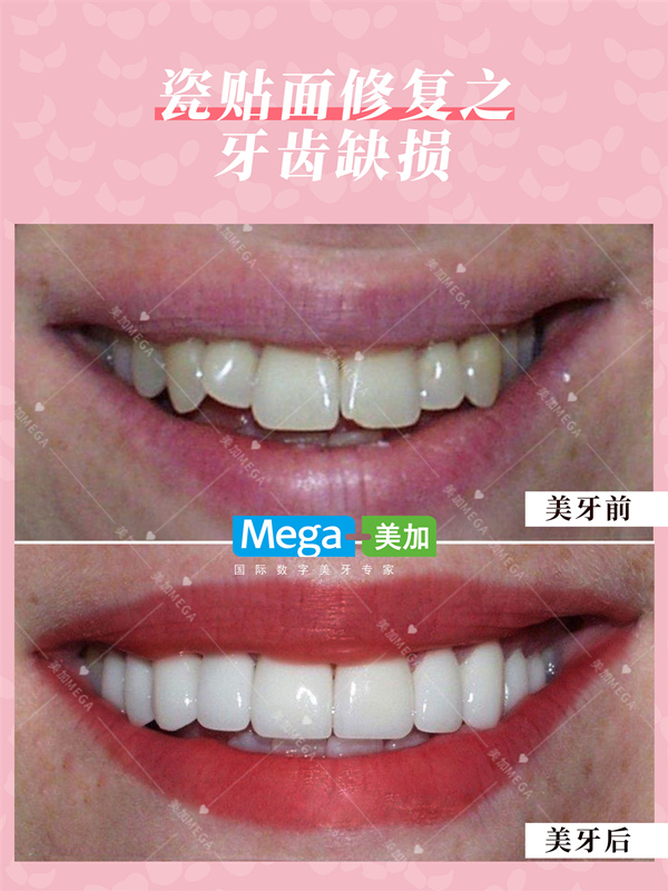 牙齿缺一块怎么办?90%的人用这个方法修复