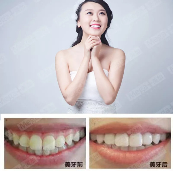 美加贴面案例丨感谢你告诉我,我又美了