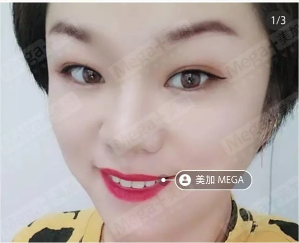 美加贴面这个小薄片,让笑容焕然一新!