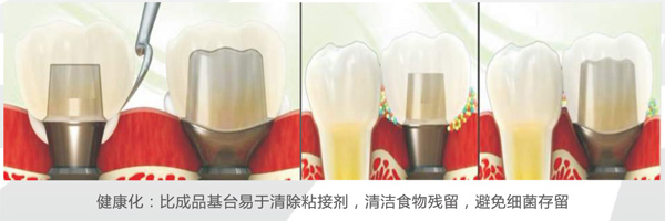 美加个性化种植基台 产品详情图 2