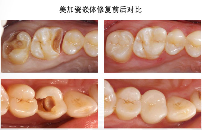 美加瓷嵌体 产品详情图 1