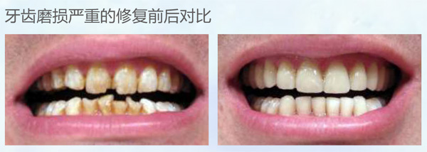 美加数码全锆牙 产品详情图 2