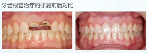 美加数码全锆牙 产品详情图 1