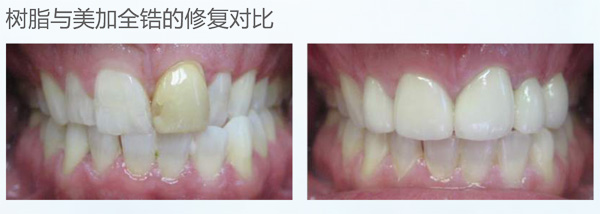美加数码全锆牙 产品详情图 4