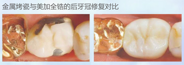 美加数码全锆牙 产品详情图 3